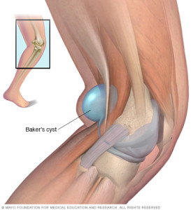 bakers cyst 2