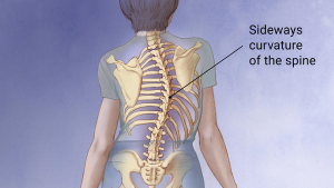 scoliosis