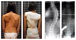 scoliosis II