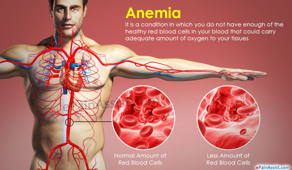 Anemia Strive For Good Health