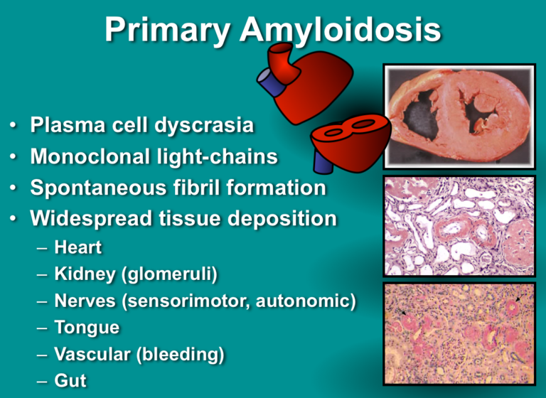 What Is Amyloidosis? | Strive For Good Health