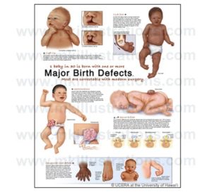 birth defects